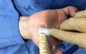 Endoscopic Carpal Tunnel Surgery Tamarac, FL